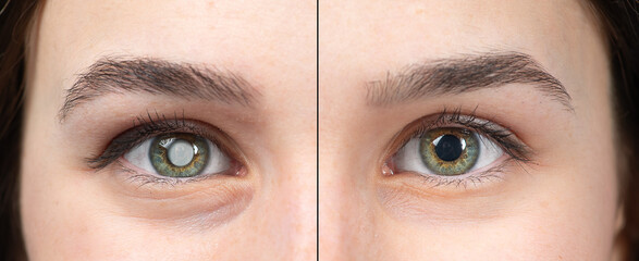 Macro of the eye of a young woman with and without cataracts