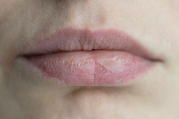 Closeup caucasian woman face with brittle and dry chapped lips, soft focus. Peeling, coarsening,...