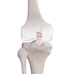 3d rendered medically accurate illustration of a torn posterior cruciate ligament