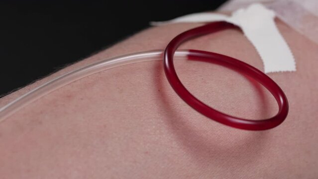 voluntary blood donation on the go and hemodialysis