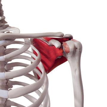 3d rendered medically accurate illustration of a torn rotator cuff