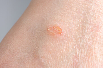 Streptoderma - dermatitis on human skin, red round spot, macro photography, bacterial inflammation