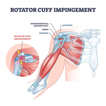 Rotator cuff 2024 pain location diagram