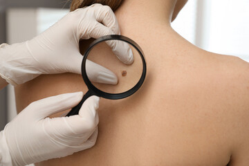 Dermatologist examining patient's birthmark with magnifying glass in clinic, closeup view - obrazy, fototapety, plakaty