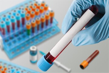 Blood sample for test with laboratory background.