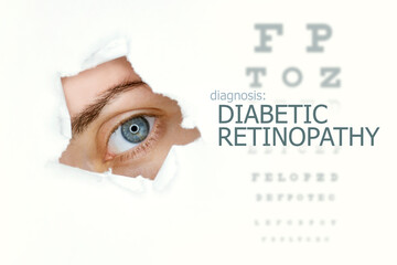 Diabetic retinopathy disease poster with eye test chart and blue eye.Isolated on white