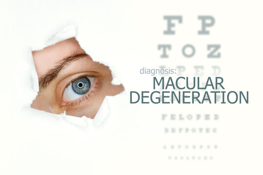 Macular degeneration disease poster with eye test chart and blue eye.Isolated on white