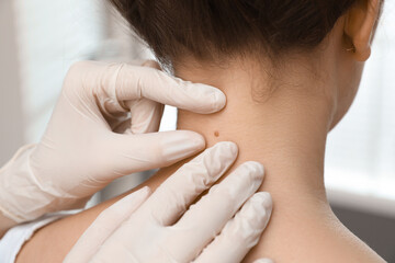 Dermatologist examining patient's birthmark in clinic, closeup view