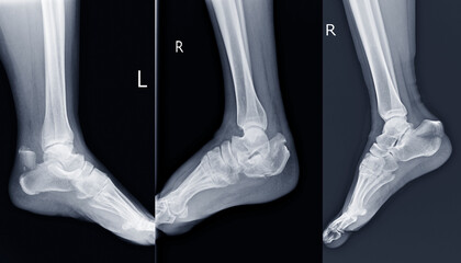 Film ankle X-ray radiograph showing heel bone broken 3 views (close fracture calcaneus) . Medical technology and healthcare concept.