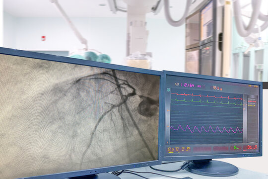 Modern Cath Lab showing LCD monitor with the doctor, nurse, and patient in the hospital, patient during treatment in Cath Lab Blurred of background.