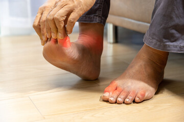 Senior Man massage foot with painful swollen gout inflammation
