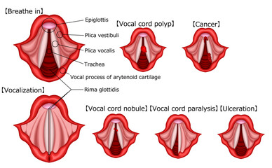 声帯　病気　構造