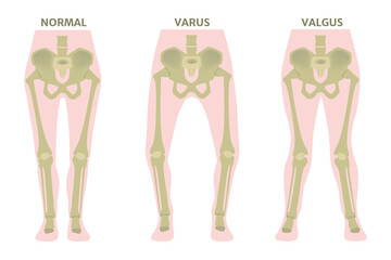 Valgus and varus leg deformities. Diagram showing the deformed bones of the lower extremities. Cosmetic pathology. Vector illustration. - obrazy, fototapety, plakaty