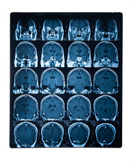 Brain stroke x-ray;MRI of the blood vessels in the brain and cerebrovascular disease or hemorrhagic stroke.