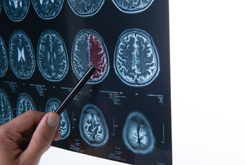 Doctors reviewing brain x-rays;MRI of the blood vessels in the brain and cerebrovascular disease or hemorrhagic stroke.