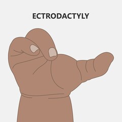 Hand finger gene prader willi band autism surgery baby simple thumb Apert minor born toes feet fused club hand Cleft Birth Ulnar multiple leg clubfoot child claw aplasia wrist forearm deformity extra