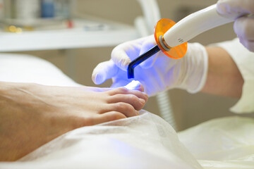 An orthopedist puts a metal nail clamp on an ingrown toenail. It shines with an ultraviolet lamp to...