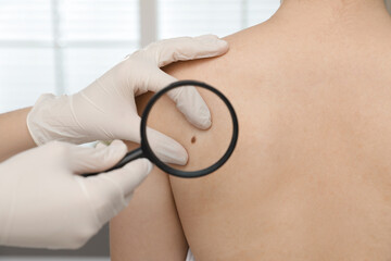 Dermatologist examining patient's birthmark with magnifying glass in clinic, closeup view