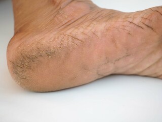 Fototapeta premium Cracked callosity woman heel. closeup photo, blurred.