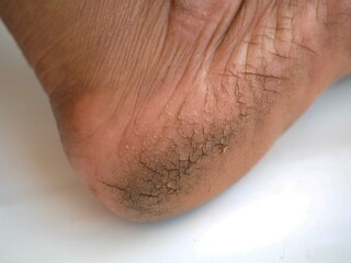 Fototapeta premium Cracks on heels of human. closeup photo, blurred.