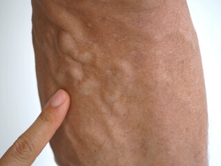 Fototapeta premium Varicose veins on a leg. closeup photo, blurred.