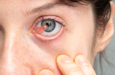 of a blue eye of a girl affected by pterygium