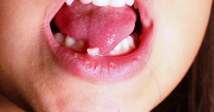 Closeup of a little girl's mouth that has a swinging tooth. Concept of loss of baby teeth