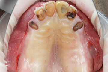 upper jaw without teeth before total dental implantation, view through the mirror © Dental Pro Content