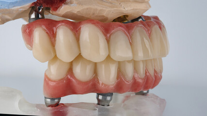 dental prostheses in bite on models, side view on a white background