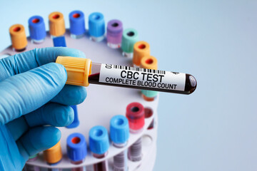 Blood sample of patient for analysis of CBC Complete Blood Count test in laboratory. Doctor with...