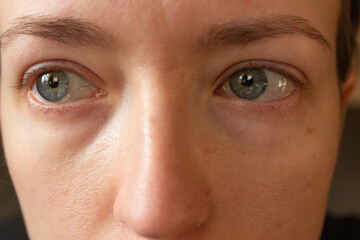 Closeup of irritated redness watery eyes of a young woman with conjunctivitis or infected, allergy.