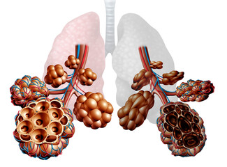 Emphysema as shortness of breath, lung disorder as a COPD illness and Chronic obstructive pulmonary disease medical concept as bronchioles and alveoli are damaged.