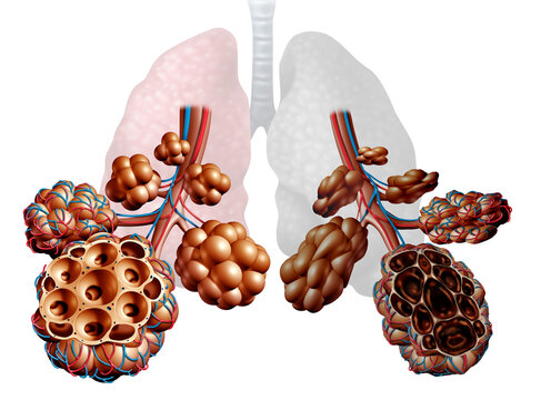Emphysema as shortness of breath, lung disorder as a COPD illness and Chronic obstructive pulmonary disease medical concept as bronchioles and alveoli are damaged.