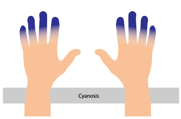 Cyanotic human hands illustration. Blue fingers