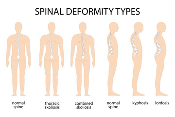 Spine deformity vector illustration. Kyphosis, lordosis spine infographic. Diagram with spine curvature and healthy spine. Posture defect. Medical, educational and scientific banner - obrazy, fototapety, plakaty