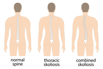 Vector illustration of spinal deformity. Kyphosis, lordosis, and scoliosis spine infographic. body posture defect. Medical, educational and scientific banner