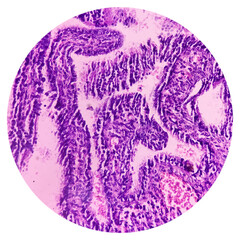 Ovarian cyst wall, luteal cyst, photo under microscope, photograph shows luteal cyst in the female ovary
