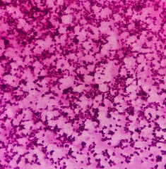 Microscopic image of vertebral lesion cytology, Inflammatory lesion, show polymorphs, lymphocytes, histiocytes,fibrous tissue, blood cell background.