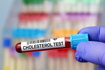 Obraz premium Blood sample of patient for analysis of Cholesterol test in laboratory. doctor with Blood tube test for Cholesterol test