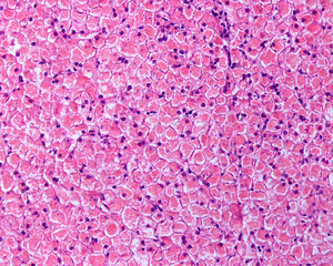 Human liver. Glycogenosis