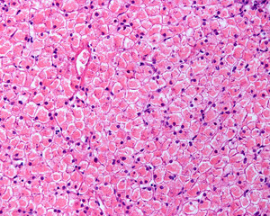 Obraz premium Human liver. Glycogenosis