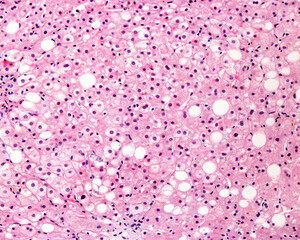 Human liver. Steatosis