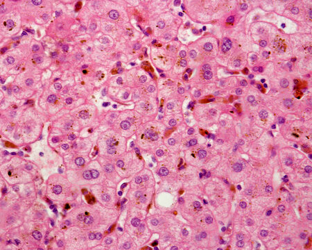 Human liver. Cholestasis. Bile pigment