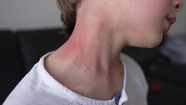 Allergic skin reaction on the childs neck and face - red rash. Symptoms of photodermatitis. Allergic reaction to sunlight
