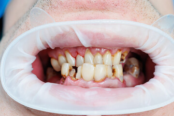 Obraz premium Spoiled teeth, poor dental hygiene, caries, Mouth disease. shattered teeth