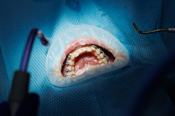 Top view of the process of brushing the patient's teeth. Teeth cleaning with water jet and saliva...