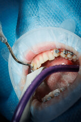 Top view of the process of brushing the patient's teeth. Teeth cleaning with water jet and saliva...