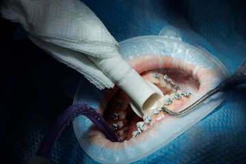 Top view of the process of brushing the patient's teeth. Teeth cleaning with water jet and saliva...