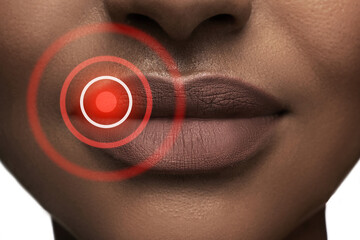 Black woman's lips affected by herpes simplex virus
