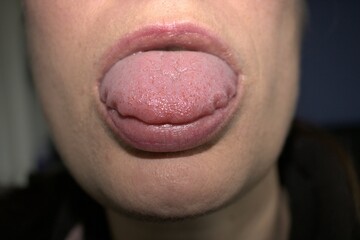 swollen enlarged white tongue with wavy ripple scalloped edges (medical name is macroglossia) and...